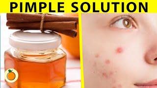 Quick Tips For Pimples | Cinnamon And Honey Paste | #Pimplesolution # pimple #homeremedy