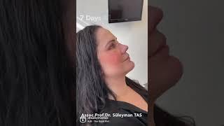 Midfacelift & Rhinoplasty & Fox Eyes | Before And 7 Days After