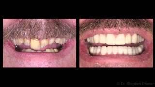 Full Mouth Rehabilitation case study for bite problems by Dr. Stephen Phelan, Oakville, Canada