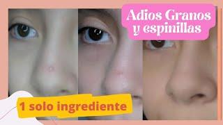 Como quitar granitos rápido//remedio casero para eliminar el acne  #eliminaracne #acne