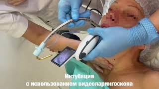 Интубация с использованием видео ларингоскопа