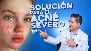 SOLUCIÓN PARA EL ACNÉ SEVERO || Consejos de un dermatólogo