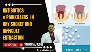 ANTIBIOTICS AND PAIN KILLERS IN DRY SOCKET AND DIFFICULT EXTRACTIONS