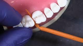 The Wedge Wands® by Garrison Dental