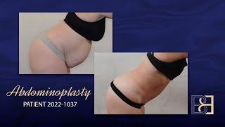 Full Abdominoplasty Including VASER Liposuction (Patient 2022-1037)