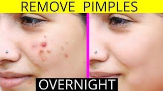 How To Remove Pimples Overnight | Acne Treatment | Anaysa