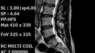 Herniated discs therapy and treatment | Piriformis syndrome | He also had stroke attack | Neuropathy