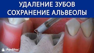 Удаление зубов — Сохранение альвеолы ©