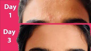 ACNE Treatment At Home | 3 day Acne REMOVAL Challenge | Acne Treatment Ayurvedic with Results