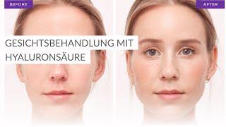 Gesichtsbehandlung mit Hyaluronsäure | Facial Design von Dr. Sina Djalaei