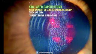 Everything you need to know about YAG LASER Capsulotomy in 30 seconds.