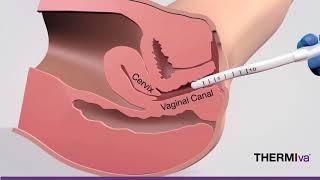 Presentation of ThermiVa Treatment Vaginal Rejuvenation