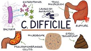 Understanding Clostridium Difficile Infection (C. Diff)