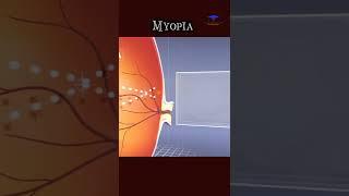 Nearsightedness ( Myopia ) and its treatment . medical video