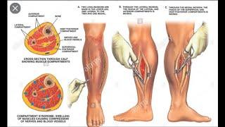 Leg Fasciotomy