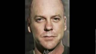 Kiefer Sutherland, Bald?