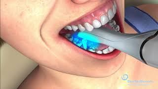 Optical Intra-Oral Scanning Procedure