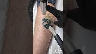 tattoo removal