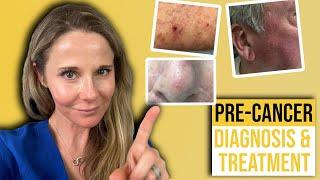 Actinic keratosis treatment guide from a Dermatologist