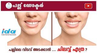 പല്ലിലെ വിടവ് അടക്കാൻ ചിലവ് എത്ര? l "Diastema: Understanding the Gap Between Teeth"