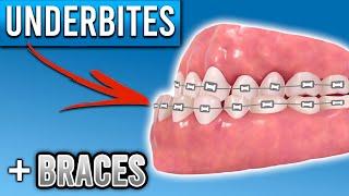 How Do Braces Fix Underbites? | Premier Orthodontics
