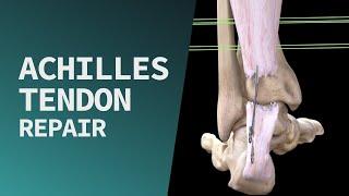 Achilles Tendon Repair