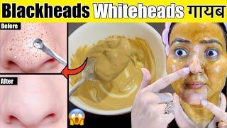 कितने भी मुश्किल Blackheads Whiteheads कील सफेद दाने हों, ये 5 Step कर लो , होगा 100% इलाज़