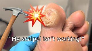 ROCK HARD FOOT CALLUS