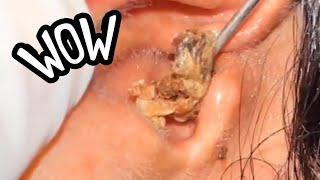 MASSIVE Ear Wax Plug Removal videos. #4k60fbs