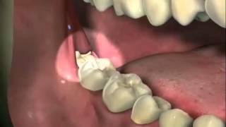 Wisdom Tooth Patient Education 2-Removal