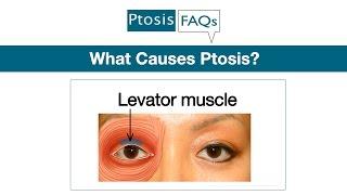 What Causes Ptosis Explained by Oculoplastic Surgeon Dr. Amiya Prasad