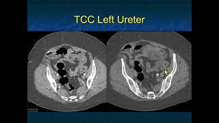 Transitional Cell Carcinoma of the Kidneys 2022: Pearls and Pitfalls - Part 3