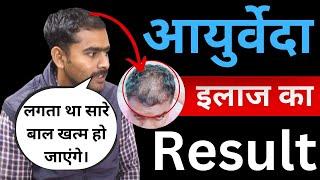 Mr. Ankit's Journey with VHCA Hair Clinic | Male Pattern Baldness Stage 3 | 5-Month Transformation