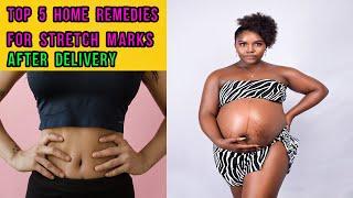 @GLAMRSTV  BEST 5 Effective Home Remedies for Pregnancy Stretch Marks| Stretch Marks after Delivery