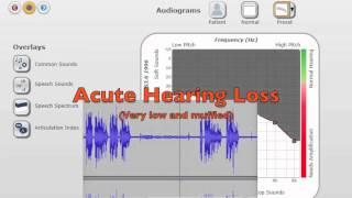 Hearing Loss - What it Sounds Like to Live This Way