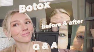 botox before and after / questions, prices, how many units?