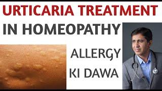 Urticaria | Pitti | एलर्जी की दवा | Urticaria Homeopathic Treatment Medicine In Hindi | Paras Homeo