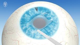 Einsetzen einer zusätzlichen Linse ins Auge (Phake IOL)
