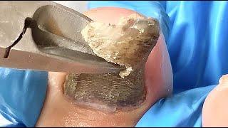 Black toenails eroded by fungus, trimmed clean【Xiao Yan Pedicure】#asmr