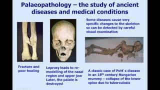 Bones, mummies, tuberculosis and ancient DNA (Helen Donoghue 17 March 2016)