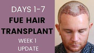 FUE Hair Transplant Week 1 | Recovery, healing, sleeping, itching, swelling, travelling