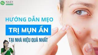 Bí kíp “thần thánh” giúp hết sạch mụn ẩn dễ dàng hơn bao giờ hết | Mỹ Duyên Salala