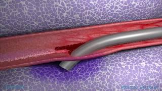 Peripheral IV Infiltration Animation