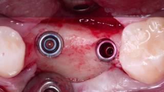 Dos implantes Hahn® Implant restaurados  con coronas BruxZir® Solid Zirconia.
