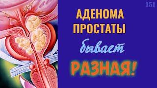 Аденома простаты бывает разная! | Лечение аденомы простаты (ДГПЖ)