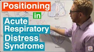 Prone Positioning in Severe ARDS