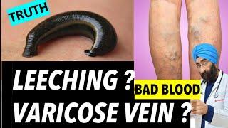 Can Leeching detox body & Cure Varicose veins | hirudotherapy | Dr.Education