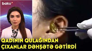 Qadının qulağından çıxanlar dəhşətə gətirdi - Maraqlı anlar | BAKU TV