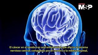 ¿Cómo funciona el cáncer en el cerebro? - #ExclusivoMSP