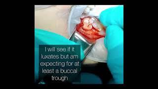 Erupted Third Molar Extraction Using Buccal Trough